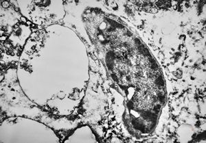 M,50y. | Pneumocystis carinii - lung